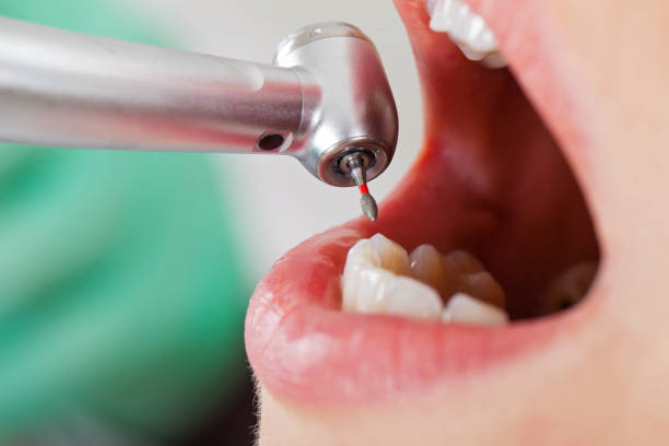 Best Emergency Dentist for Lost Fillings or Crowns in Lambertville, MI
